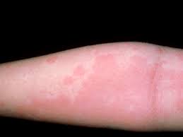 Most deaths due to anaphylaxis can be prevented by careful food allergen avoidance measures and immediate administration of an. Photos And Symptoms Of Common Food Allergy Symptoms
