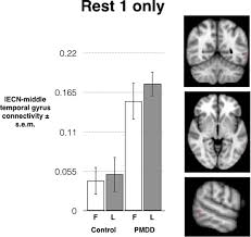 It affects around 1.8% to 5.8% of women, and it can be a disabling factor. Resting State Functional Connectivity In Women With Pmdd Translational Psychiatry