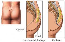 When the cyst became infected and filled with pus, it is now referred to as pilonidal abscess which is quite painful. Pilonidal Cyst Uva Health
