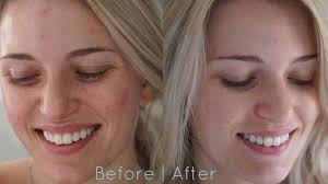 Light therapy is proving effective in soothing, and even reversing rosacea symptoms. Neutrogena Light Therapy Acne Mask Review Morgan Bullard