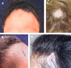 Androgenetische Alopezie Swiss Medical Forum