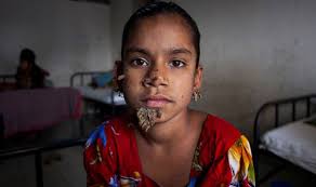 Epidermodysplasia verruciformis (ev) er en ekstremt sjelden hudtilstand som kan forårsake barklignende vekst. Tree Girl With Bark Like Warts On Her Face Becomes First Female Ever To Be Diagnosed World News Express Co Uk