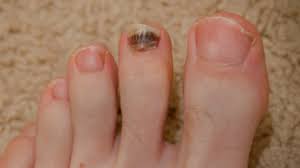 Even if you think your toenails look clean, they are microscopically filthy almost all the time more rarely, but important to note, is that a melanoma (skin cancer) under the toenail can cause the nail technically covering your toenails in polish is fine; Toenail Problems Causes Symptoms And Treatments