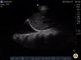 Pleural fluid/serum protein ratio >0.5. Pulmonary Tpa