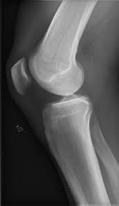 Image result for Knee XRay