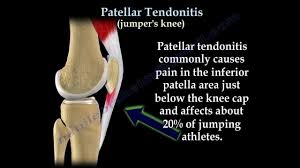 Patellar Tendonitis Jumper S Knee Everything You Need To Know Dr Nabil Ebraheim Patellar Tendonitis Tendinitis Knee Tendonitis