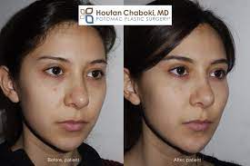 Cheek augmentation with dermal fillers is an effective option to restore lost volume and improve contour. Fill Flat Cheeks With Facial Fillers