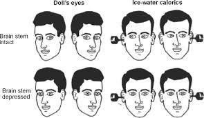 Image result for Oculovestibular Testing
