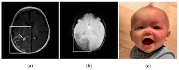 A Review of Sturge–Weber Syndrome Brain Involvement, Cannabidiol Treatment  and Molecular Pathways