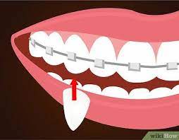 How To Make Vampire Fangs If You Have Braces Vampire Fangs Halloween Fangs Vampire Costume Diy