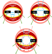 A Modified McCall Culdoplasty in Pelvic Organ Prolapse Surgery: Anatomical  and Functional Outcomes