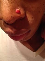 How To Identify And Get Rid Of Keloids Caused By Piercings Pierced