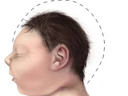 microcephaly causes symptoms and treatment