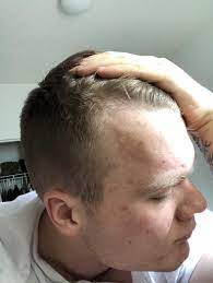 Am I Going Bald Is It Possible This Is Just My Hairline 20 Yo I Love My Hair And This Is Depressing Hair Beauty Skin Deals Going Bald Bald Heads Balding