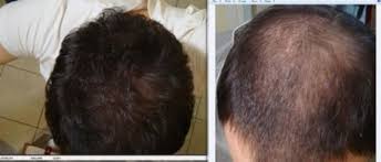 While transdermal application is the most popular use of microneedles, intraocular and intracochlear microneedle drug delivery systems are emerging. How Often To Microneedle For Hair Loss It Depends Studies Photos