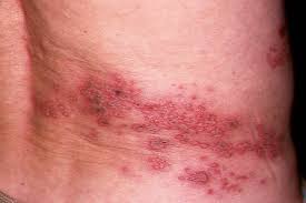 Maksudnya, sekiranya selama setahun seseorang wanita itu tidak haid, beliau boleh dikatakan sedang mengalami fasa menopause (monopos). Kayap Virus Yang Bangkit Dari Tidur Dr Nurjasmine Aida Jamani The Malaysian Medical Gazette