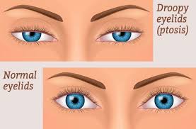What To Do If You Have Drooping Eyelids Ptosis Droopy Eyelids Drooping Eyelids Eye Lift Surgery