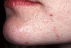 Multiple treatment agents and formulations are available, with each agent targeting a specific area within acne pathogenesis. Pictures Different Types Of Acne How To Treat Them