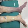 Blood clot, fat emboli, air emboli, thrombus, thromboembolism. 1