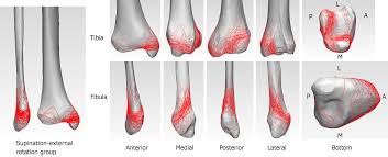 Posterior malleolus fractures usually occur in association with bimalleolar or trimalleolar ankle fractures. Three Dimensional Computed Tomography Mapping Of Posterior Malleolar Fractures