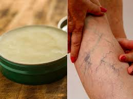 Natural Remedy To Reduce Varicose Veins Article 2022