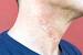 Razor Bumps Or Std