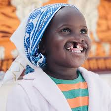 Image result for Cleft Lip