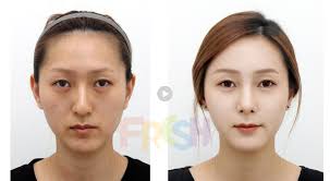 Find the part 2 on foundatio. Facial Fat Grafting Nose Tip Aegyo Filler Korean Plastic Surgery Brazilian Butt Lift Fresh Plastic Surgery