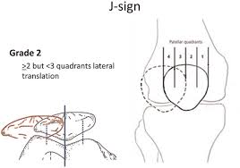Image result for Patella Tracking Assessment