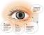 Ingrown Eyelash Inside Eyelid