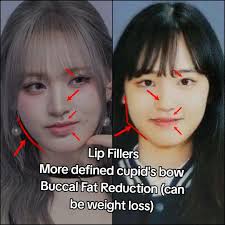 Ive Liz Surgery Analysis