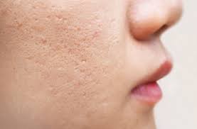 Top 3 Cách Tái Tạo Da Bị Sẹo Rỗ Từ Chuyên Gia