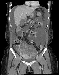 Learn more about diagnosis, staging and treatment. Peritoneal Metastases Radiology Reference Article Radiopaedia Org