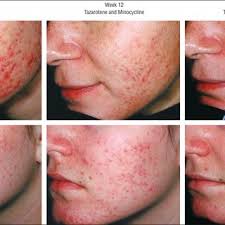 Improvement in acne with tazarotene plus minocycline hydrochloride...