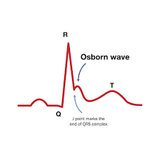 Image result for Epsilon Wave