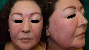 Jun 06, 2021 · a ploeren, près de vannes, (morbihan), un homme est décédé dans la nuit de samedi à dimanche. Persistent Facial Oedema And Erythema In A Woman An Uncommon Manifestation Of Chronic Cutaneous Lupus Erythematosus