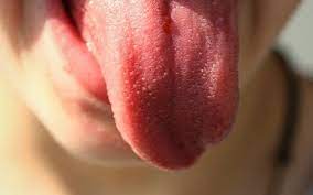 Granitos En La Lengua Antojo O Carencia El Sol De Puebla Noticias Locales Policiacas Sobre Mexico Puebla Y El Mundo