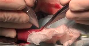 Résultat de recherche d'images pour "papilloma penis"