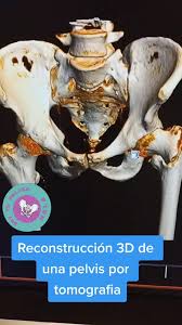 Reconstrucción 3D de una pelvis por tomografía | TikTok