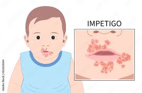 impetigo oral poison ivy sepsis bacterial children dermatitis disease warts  HPV virus blister face acne Itchy skin soreness reddish cancer ulcer mouth  viral cold zoster lip rash nose baby infant 스톡 벡터 |