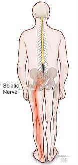 Sciatica Causes Symptoms Treatment Prevention Pain Relief