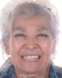 From the depths of struggle, a phoenix rises: Josefa’s #new life, a  testament to the power of hope #losalgodonesimplants #fullarchdentistry  #implantsmexico #smilemakeover #allon4 #changinglives ...