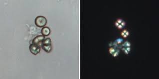 Era Edta On Twitter Eraedtadialogue By Ferraromanuel And Federic33689424 46 Year Old White Male Man W Several Episodes Of Renal Colic And Spontaneous Passage Of Stones Ckd Ct Scan 1 Small Stone In