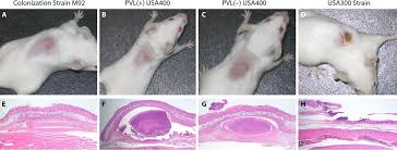 The medical experts agreed the child suffered from pvl. Methicillin Resistant Staphylococcus Aureus Molecular Characterization Evolution And Epidemiology Clinical Microbiology Reviews