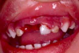 Pediatric Dental Trauma Dunes Dental 4 Kids