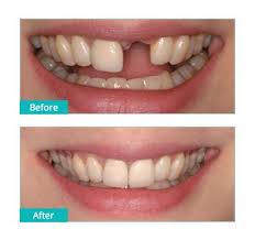 Toothpaste that gives you a healthy smile, with specialized solutions tailored to you. Single Tooth Implants Brooklyn Dental Implants Center