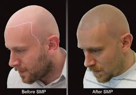 U personally invented the ugraft system which is an advanced form of hair. Pin On Bald Guy Hair Tattoos