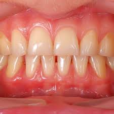 Our dental office is conveniently located on the north side of candelaria, just between san pedro and san mateo dr. Albuquerque Nm Drill Free Dentistry Air Abrasion For Tooth Decay And Cavities