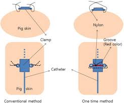 An integrative review of the literature (available up to december. Usefulness Of New Method Of Central Venous Catheter Securement Using A Continuous Suture The American Journal Of Emergency Medicine
