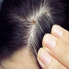 Scabs On Scalp A Detailed Guide Dry Scalp Remedy Hair Scalp Problems Scalp Treatment Diy
